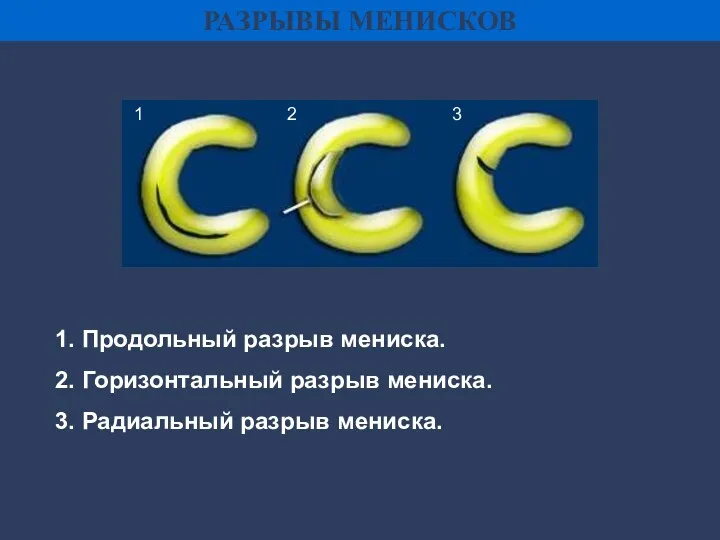 РАЗРЫВЫ МЕНИСКОВ 1. Продольный разрыв мениска. 2. Горизонтальный разрыв мениска.