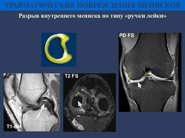 Разрыв внутреннего мениска по типу «ручки лейки» Т2 FS PD FS ТРАВМАТИЧЕСКИЕ ПОВРЕЖДЕНИЯ МЕНИСКОВ Т1-ВИ