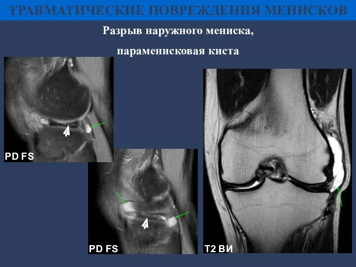 Разрыв наружного мениска, параменисковая киста PD FS PD FS Т2 ВИ ТРАВМАТИЧЕСКИЕ ПОВРЕЖДЕНИЯ МЕНИСКОВ