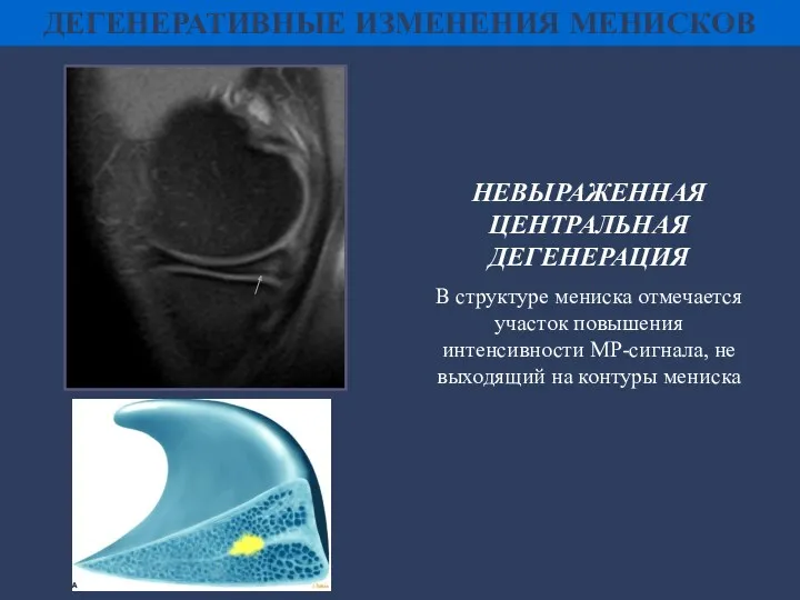 ДЕГЕНЕРАТИВНЫЕ ИЗМЕНЕНИЯ МЕНИСКОВ НЕВЫРАЖЕННАЯ ЦЕНТРАЛЬНАЯ ДЕГЕНЕРАЦИЯ В структуре мениска отмечается