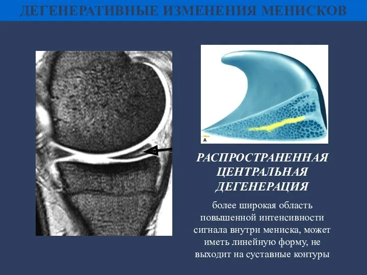 ДЕГЕНЕРАТИВНЫЕ ИЗМЕНЕНИЯ МЕНИСКОВ РАСПРОСТРАНЕННАЯ ЦЕНТРАЛЬНАЯ ДЕГЕНЕРАЦИЯ более широкая область повышенной