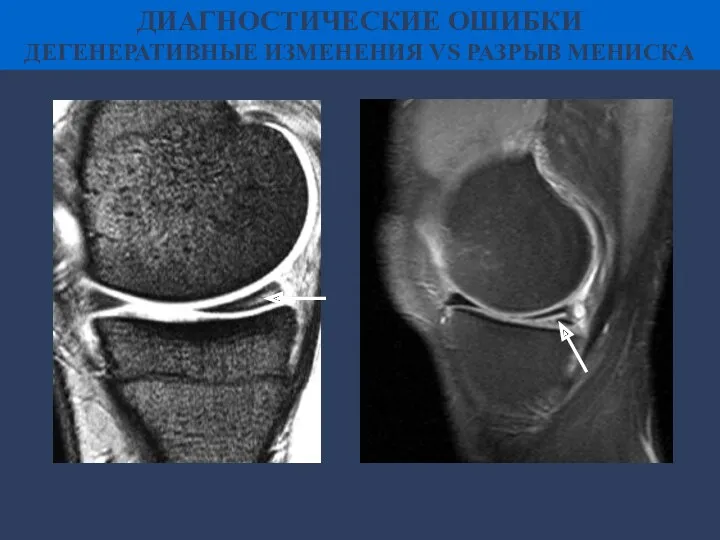 ДИАГНОСТИЧЕСКИЕ ОШИБКИ ДЕГЕНЕРАТИВНЫЕ ИЗМЕНЕНИЯ VS РАЗРЫВ МЕНИСКА