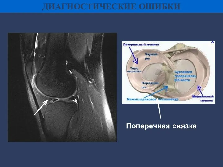 ДИАГНОСТИЧЕСКИЕ ОШИБКИ Поперечная связка