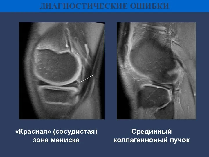 ДИАГНОСТИЧЕСКИЕ ОШИБКИ «Красная» (сосудистая) зона мениска Срединный коллагенновый пучок