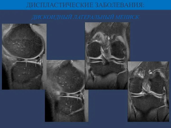 ДИСКОИДНЫЙ ЛАТЕРАЛЬНЫЙ МЕНИСК ДИСПЛАСТИЧЕСКИЕ ЗАБОЛЕВАНИЯ: