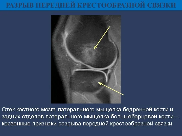 РАЗРЫВ ПЕРЕДНЕЙ КРЕСТООБРАЗНОЙ СВЯЗКИ Отек костного мозга латерального мыщелка бедренной