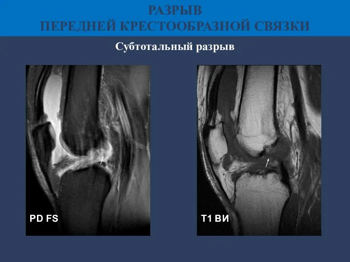 PD FS Т1 ВИ РАЗРЫВ ПЕРЕДНЕЙ КРЕСТООБРАЗНОЙ СВЯЗКИ Субтотальный разрыв