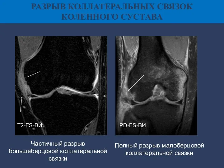 РАЗРЫВ КОЛЛАТЕРАЛЬНЫХ СВЯЗОК КОЛЕННОГО СУСТАВА Т2-FS-ВИ PD-FS-ВИ Частичный разрыв большеберцовой