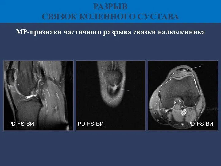 МР-признаки частичного разрыва связки надколенника РАЗРЫВ СВЯЗОК КОЛЕННОГО СУСТАВА PD-FS-ВИ PD-FS-ВИ PD-FS-ВИ PD-FS-ВИ