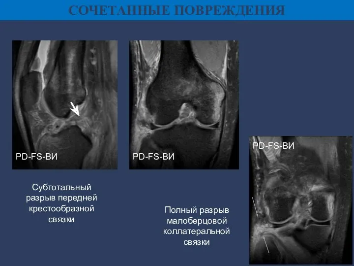 СОЧЕТАННЫЕ ПОВРЕЖДЕНИЯ PD-FS-ВИ PD-FS-ВИ PD-FS-ВИ Субтотальный разрыв передней крестообразной связки Полный разрыв малоберцовой коллатеральной связки