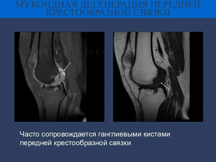 МУКОИДНАЯ ДЕГЕНЕРАЦИЯ ПЕРЕДНЕЙ КРЕСТООБРАЗНОЙ СВЯЗКИ Часто сопровождается ганглиевыми кистами передней крестообразной связки