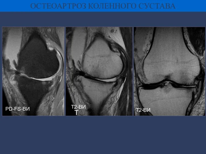 ОСТЕОАРТРОЗ КОЛЕННОГО СУСТАВА PD-FS-ВИ Т Т2-ВИ Т2-ВИ