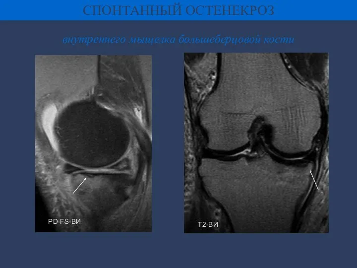 СПОНТАННЫЙ ОСТЕНЕКРОЗ внутреннего мыщелка большеберцовой кости PD-FS-ВИ Т2-ВИ