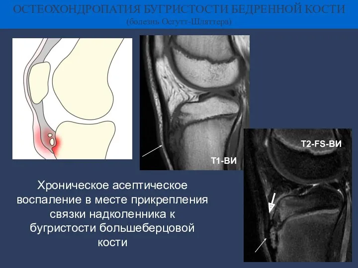 ОСТЕОХОНДРОПАТИЯ БУГРИСТОСТИ БЕДРЕННОЙ КОСТИ (болезнь Осгутт-Шляттера) Т1-ВИ Т2-FS-ВИ Хроническое асептическое