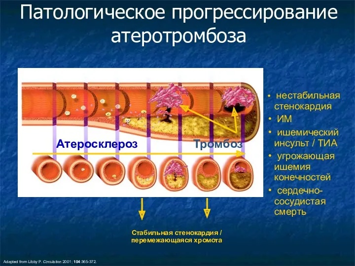 Патологическое прогрессирование атеротромбоза Adapted from Libby P. Circulation 2001; 104:365-372. Стабильная стенокардия /