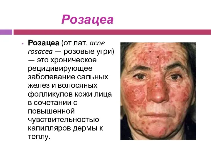 Розацеа Розацеа (от лат. acne rosacea — розовые угри) — это хроническое рецидивирующее