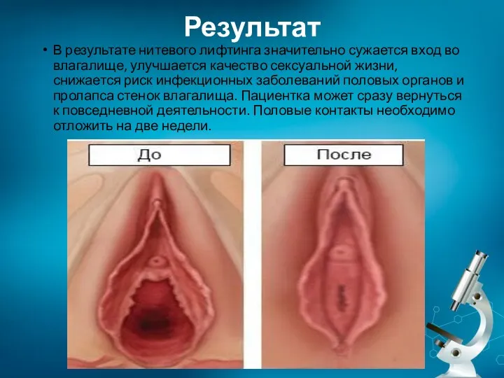 Результат В результате нитевого лифтинга значительно сужается вход во влагалище,