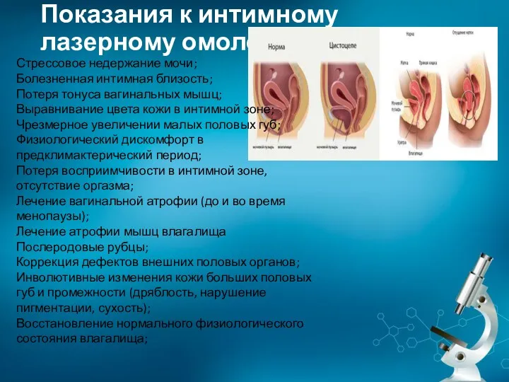 Показания к интимному лазерному омоложению: Стрессовое недержание мочи; Болезненная интимная