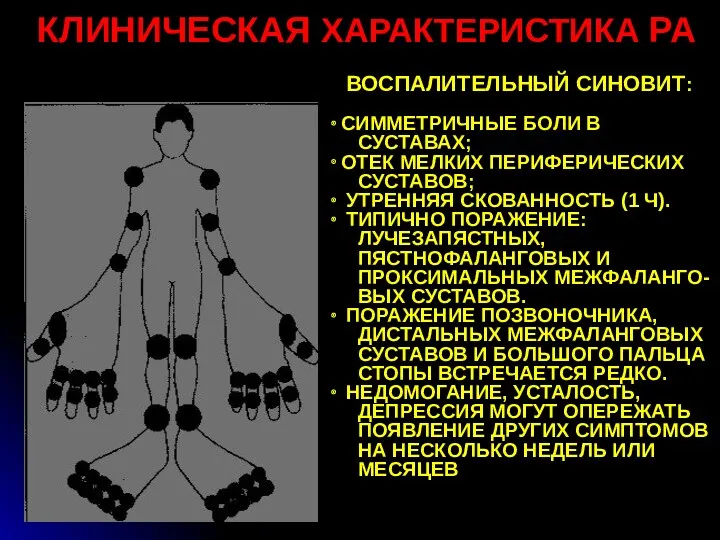 КЛИНИЧЕСКАЯ ХАРАКТЕРИСТИКА РА ВОСПАЛИТЕЛЬНЫЙ СИНОВИТ: ∙ СИММЕТРИЧНЫЕ БОЛИ В СУСТАВАХ;