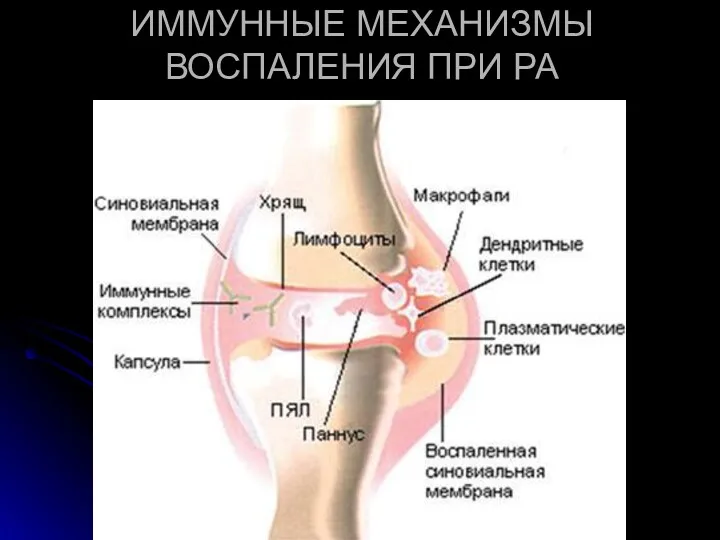 ИММУННЫЕ МЕХАНИЗМЫ ВОСПАЛЕНИЯ ПРИ РА