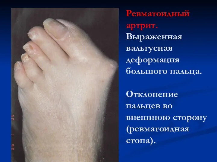 Ревматоидный артрит. Выраженная вальгусная деформация большого пальца. Отклонение пальцев во внешнюю сторону (ревматоидная стопа).