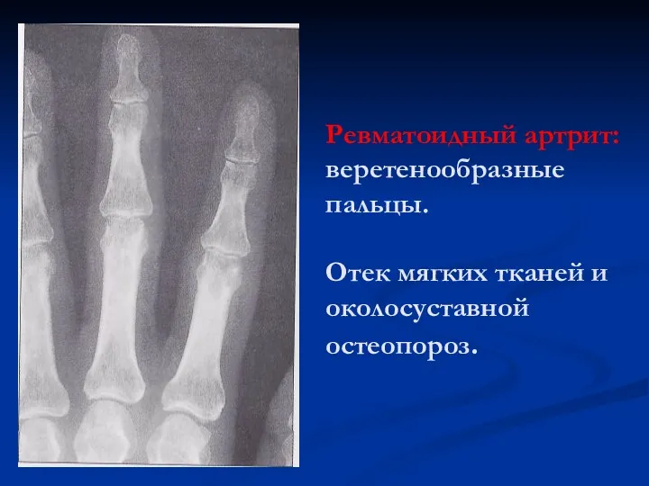 Ревматоидный артрит: веретенообразные пальцы. Отек мягких тканей и околосуставной остеопороз.