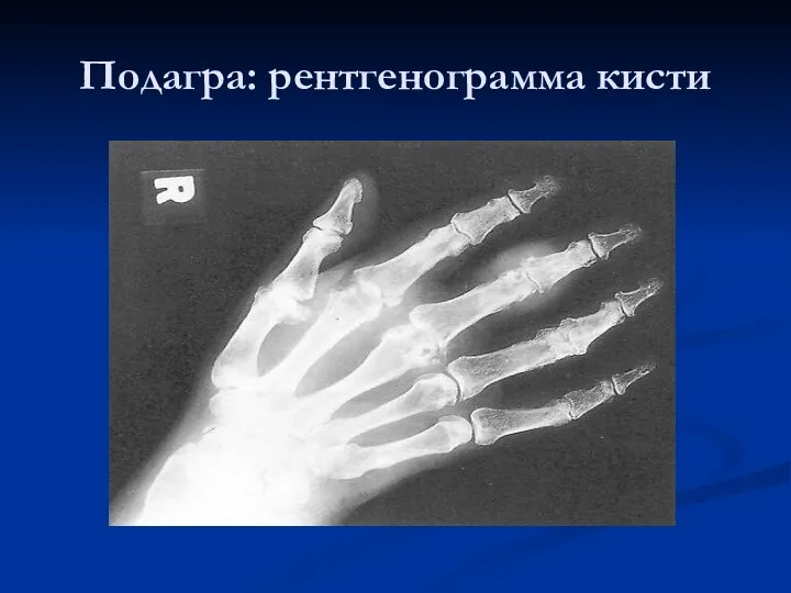 Подагра: рентгенограмма кисти