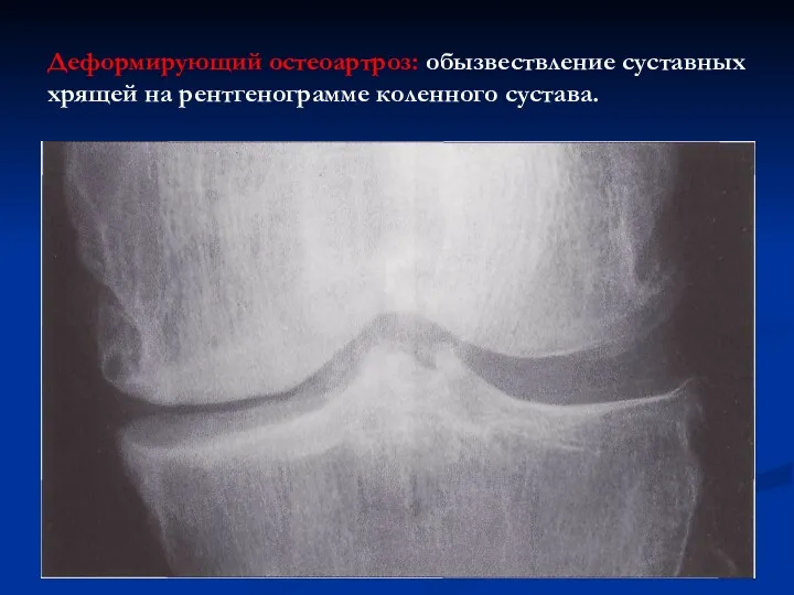 Деформирующий остеоартроз: обызвествление суставных хрящей на рентгенограмме коленного сустава.