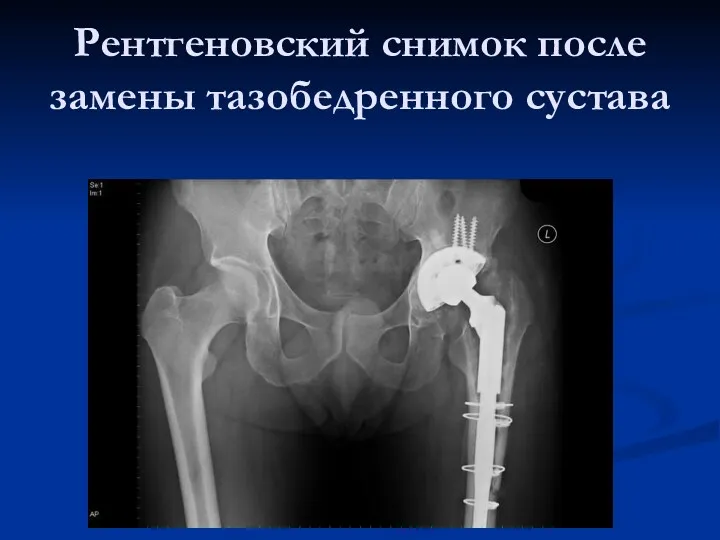 Рентгеновский снимок после замены тазобедренного сустава
