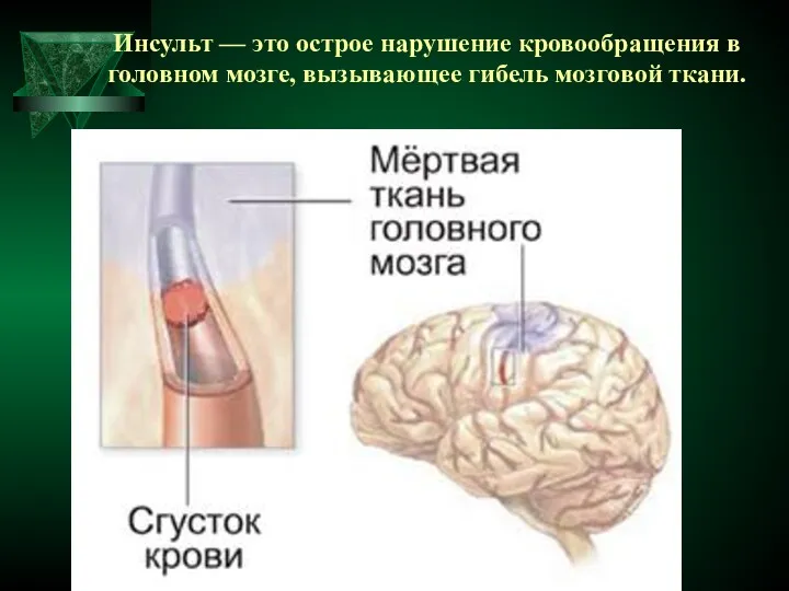 Инсульт — это острое нарушение кровообращения в головном мозге, вызывающее гибель мозговой ткани.