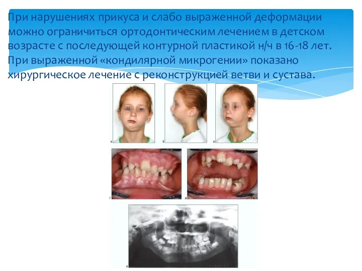 При нарушениях прикуса и слабо выраженной деформации можно ограничиться ортодонтическим