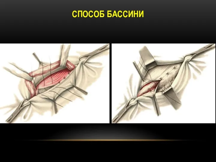 СПОСОБ БАССИНИ