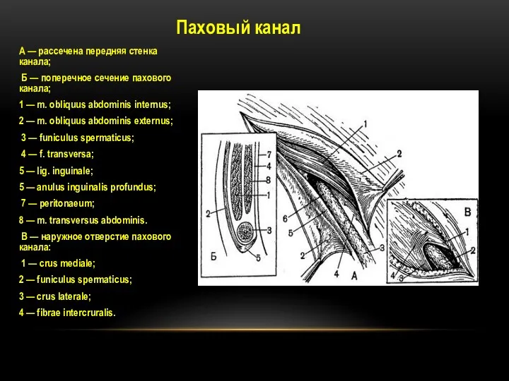 Паховый канал А — рассечена передняя стенка канала; Б —