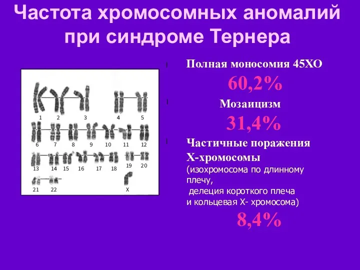 Частота хромосомных аномалий при синдроме Тернера l Полная моносомия 45ХО 60,2% l Частичные