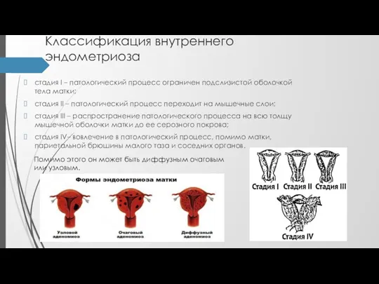 Классификация внутреннего эндометриоза cтадия I – патологический процесс ограничен подслизистой