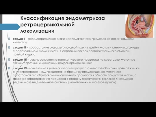 Классификация эндометриоза ретроцервикальной локализации стадия I – эндометриоидные очаги располагаются