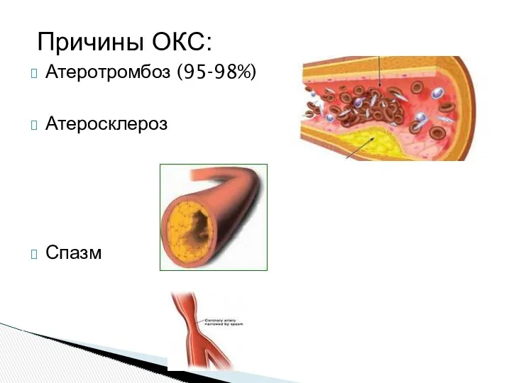Причины ОКС: Атеротромбоз (95-98%) Атеросклероз Спазм