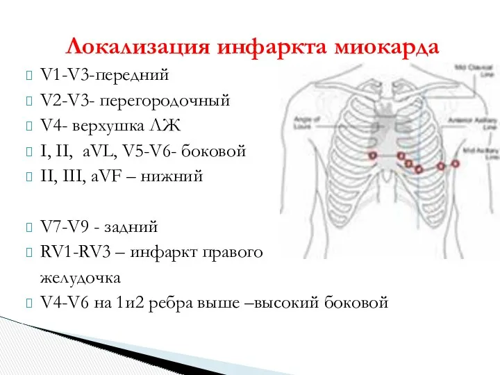 Локализация инфаркта миокарда V1-V3-передний V2-V3- перегородочный V4- верхушка ЛЖ I, II, aVL, V5-V6-