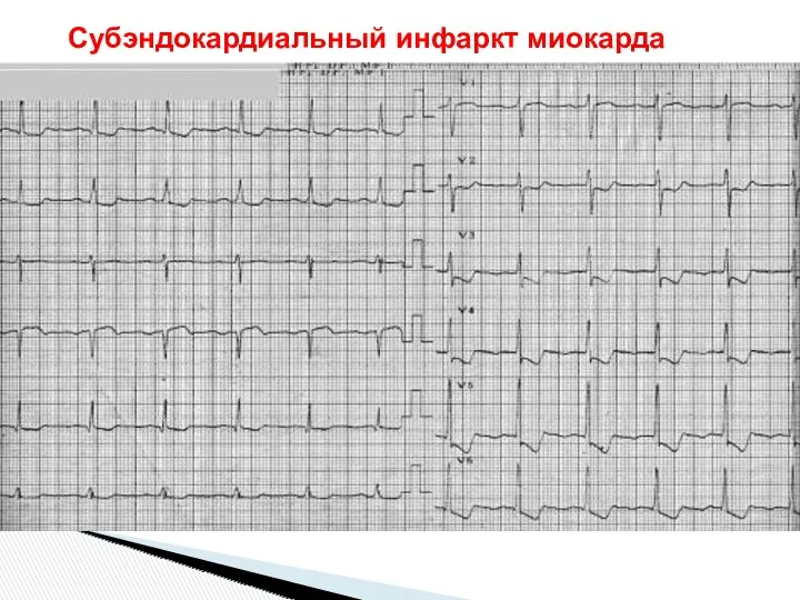 Субэндокардиальный инфаркт миокарда