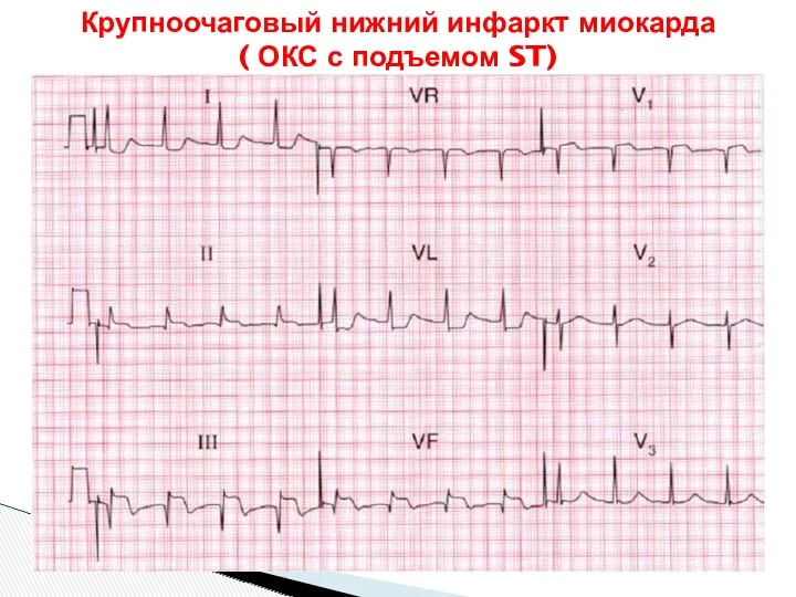 Крупноочаговый нижний инфаркт миокарда ( ОКС с подъемом ST)