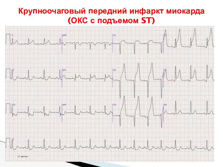 Крупноочаговый передний инфаркт миокарда (ОКС с подъемом ST)
