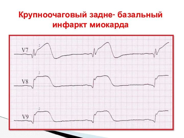 Крупноочаговый задне- базальный инфаркт миокарда