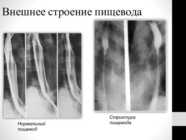 Внешнее строение пищевода Нормальный пищевод Стриктура пищевода