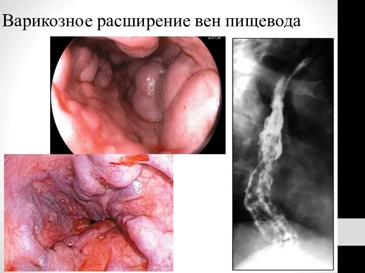 Варикозное расширение вен пищевода