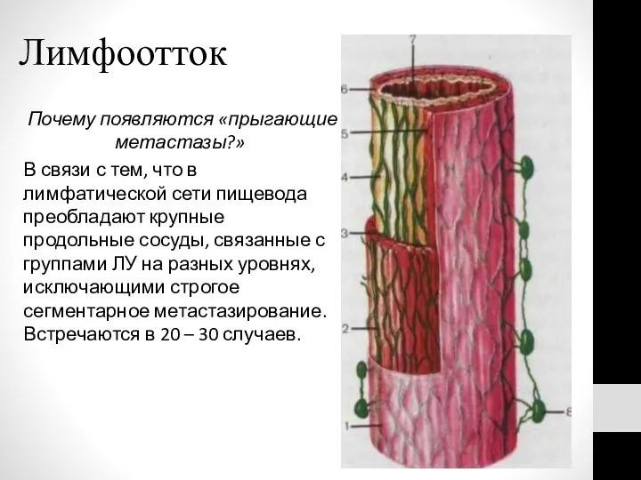 Лимфоотток Почему появляются «прыгающие метастазы?» В связи с тем, что