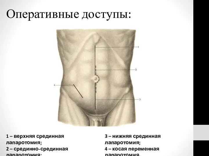 Оперативные доступы: 1 – верхняя срединная лапаротомия; 2 – срединно-срединная