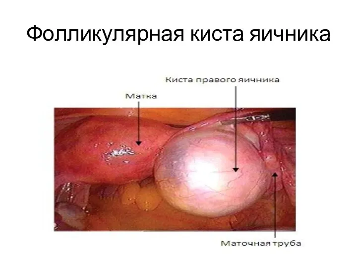 Фолликулярная киста яичника