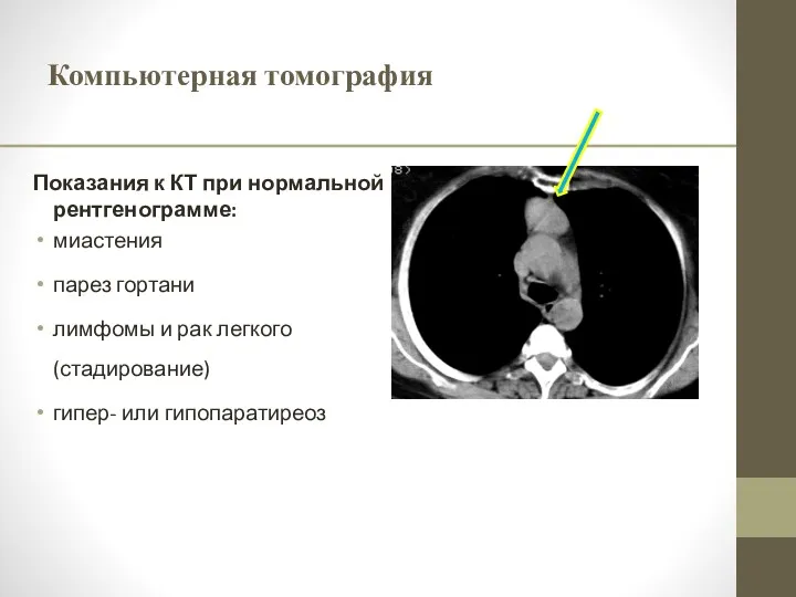 Компьютерная томография Показания к КТ при нормальной рентгенограмме: миастения парез