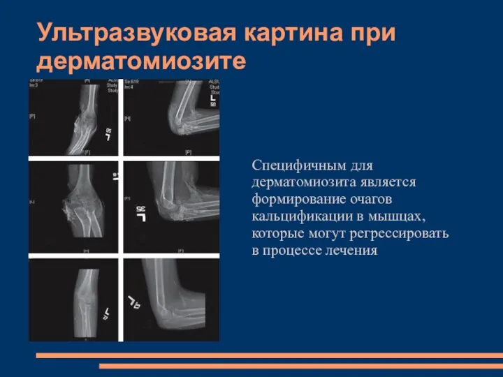 Ультразвуковая картина при дерматомиозите Специфичным для дерматомиозита является формирование очагов