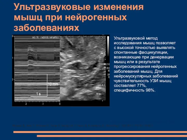 Ультразвуковые изменения мышц при нейрогенных заболеваниях Ultrasonographic detection of fasciculations